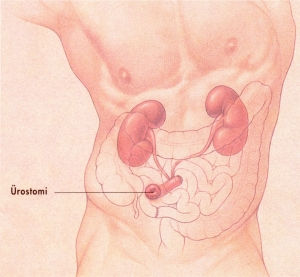 Ostomi Nedir